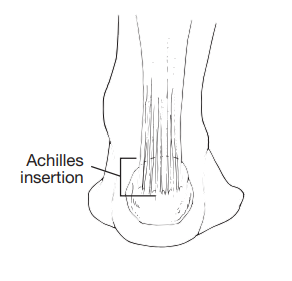 Illustration showing the back of the heel, showing where the Achilles inserts on the heel bone.