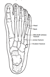 Illustration of a top-down look at the bones in the foot, showing the different areas where the 5th metatarsal can break.