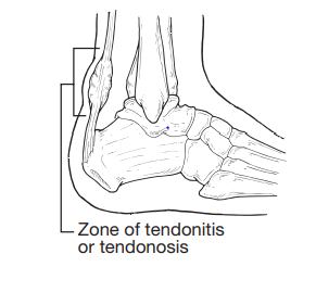 Illustration showing the bones and bands on the heel of a foot, highlighting the Zone of tendonitis.