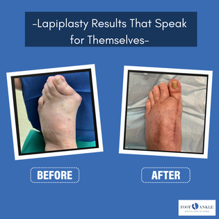 Lapiplasty - Foot and Ankle Specialists of Ames